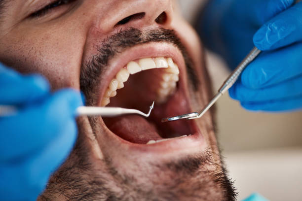 Best Emergency Dental Care for Broken or Chipped Teeth in Parkston, SD