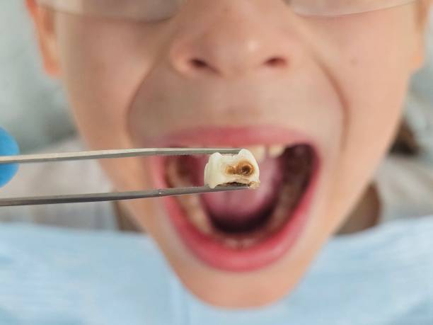 Best After-Hours Dental Trauma Care in Parkston, SD